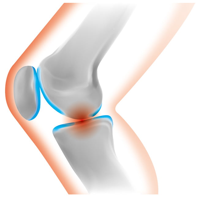 骨盤矯正（整体）、膝関節痛の図