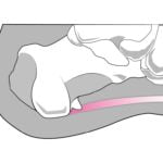 踵骨棘の図