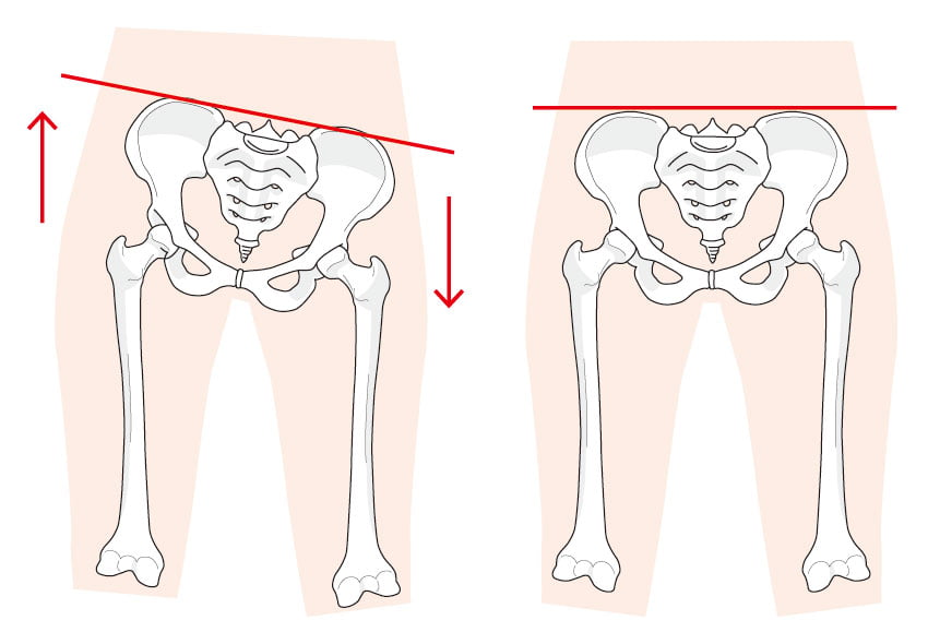 整体　むずむず足症候群の説明の骨盤イラスト