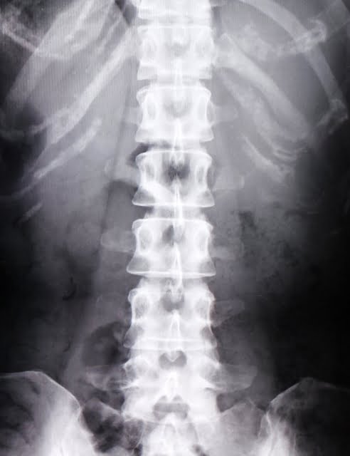 骨盤矯正（整体）の効果を説明する背骨のレントゲン画像