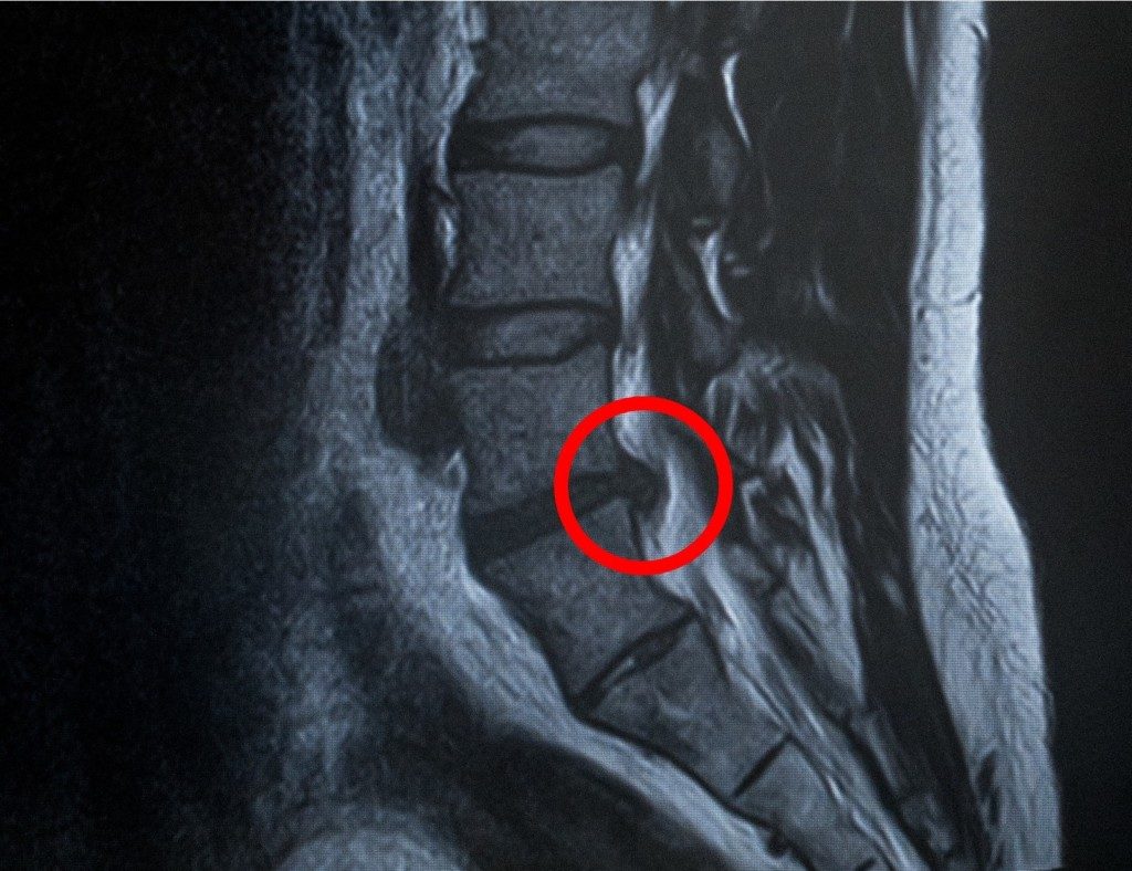 整体（骨盤矯正）凡座、脊柱管狭窄症のレントゲン画像