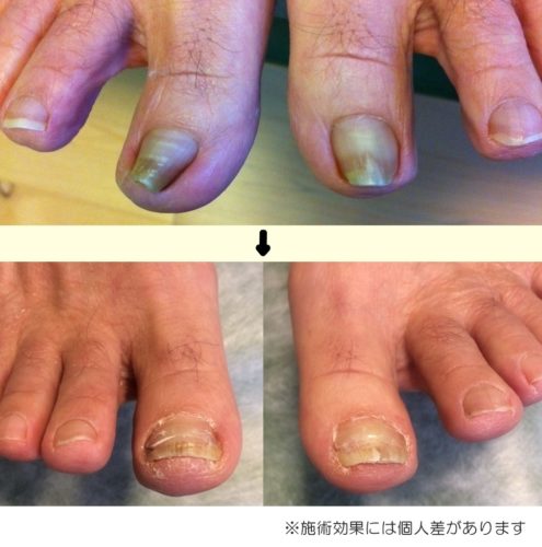 北摂豊中市蛍池の巻き爪矯正　巻き爪矯正前と後の画像
