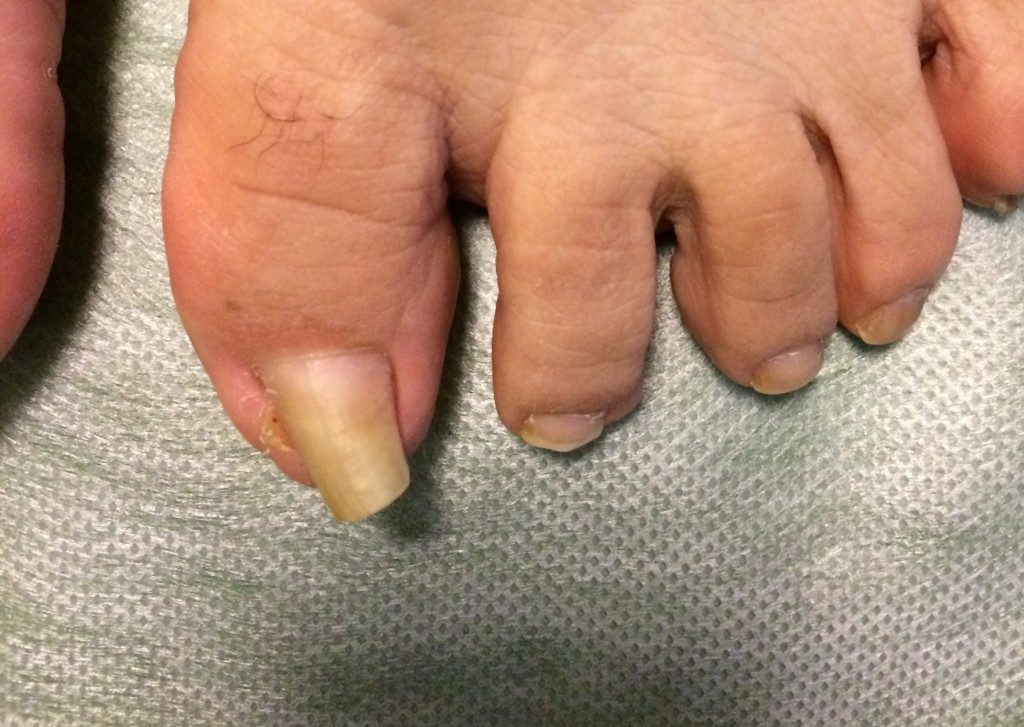 豊中の巻き爪矯正：巻き爪ケア、伸びすぎの爪