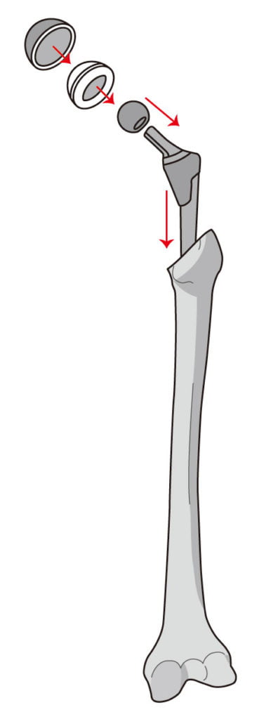 骨盤矯正（整体）股関節痛　人工股関節関節のイラスト